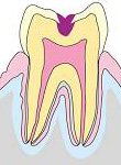 虫歯の進行c2